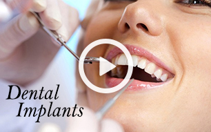 Bird Rock Dental Implants