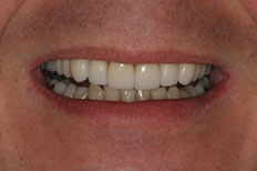 Veneers Case 2 After