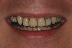 Veneers case 2 before