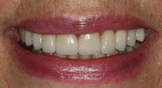 case 3 study veneers after