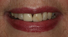 case 3 study veneers before